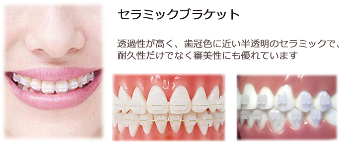 セラミックブラケット