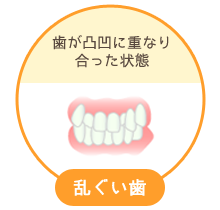 乱ぐい歯：歯が凸凹に重なり合った状態