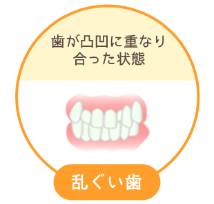 乱ぐい歯：歯が凸凹に重なり合った状態
