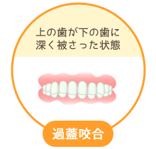 過蓋咬合：上の歯が下の歯に深く被さった状態