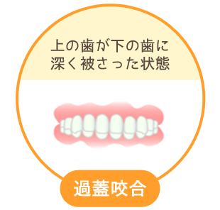 過蓋咬合：上の歯が下の歯に深く被さった状態