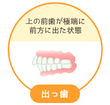 出っ歯：上の前歯が極端に前方に出た状態