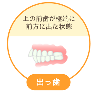 出っ歯：上の前歯が極端に前方に出た状態