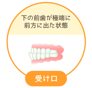 受け口：下の前歯が極端に前方に出た状態