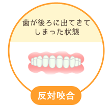反対咬合：歯が後ろに出てきてしまった状態