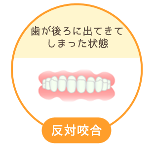 反対咬合：歯が後ろに出てきてしまった状態