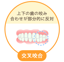 交叉咬合：上下の歯の咬み合わせが部分的に反対
