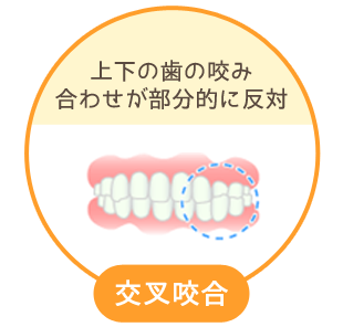 交叉咬合：上下の歯の咬み合わせが部分的に反対