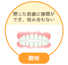 開咬：閉じた前歯に隙間ができ、咬み合わない
