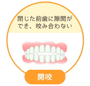 開咬：閉じた前歯に隙間ができ、咬み合わない