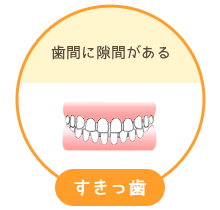 すきっ歯：歯間に隙間がある