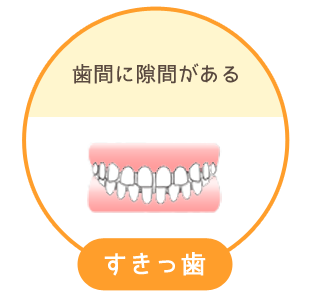 すきっ歯：歯間に隙間がある