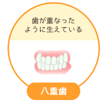 八重歯：上下の歯の咬み合わせが部分的に反対