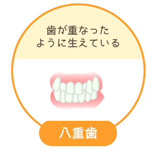 八重歯：上下の歯の咬み合わせが部分的に反対